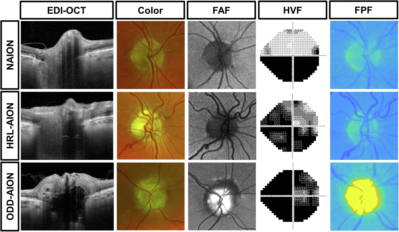 It’s known that optic disc drusen (ODD) is a risk factor in patients who have early-onset NAION. Although hyperreflective lines are an indication of ODD, the present study has found that they do not increase the risk of early-onset NAION. These images from the study show representative examples of patients with NAION, NAION with hyperreflective lines and NAION with optic disc drusen.